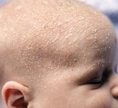 como tirar casquinhas da cabeca do bebe