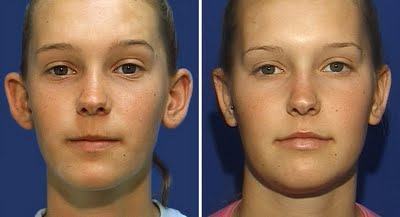 foto antes e depois cirurgia de orelha de abano