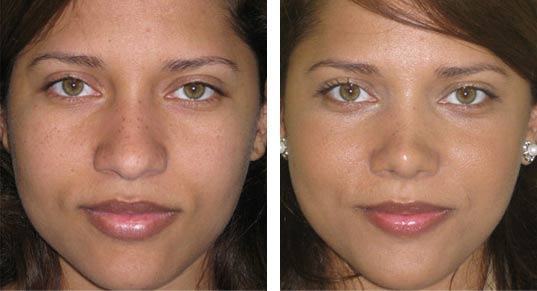 Cirurgia para nariz grande Rinoplastia antes e depois