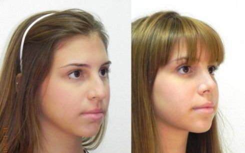 fotos de rinoplastia antes de depois em adolescente