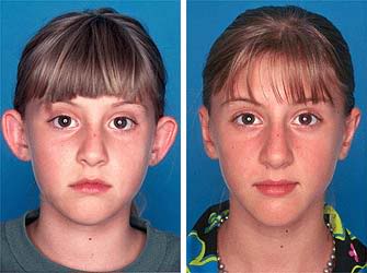 Cirurgia para orelha de abano, Otoplastia (fotos antes e depois)