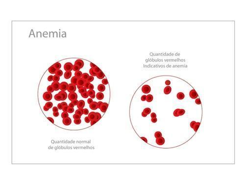 Remédios e Alimentos para Anemia, Tratamento saudável