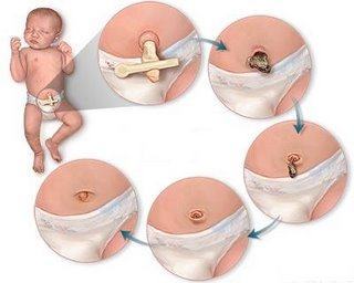 Como cuidar do umbigo do bebê após o nascimento