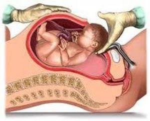 Fazer parto normal ou cesárea… Saiba as Diferenças