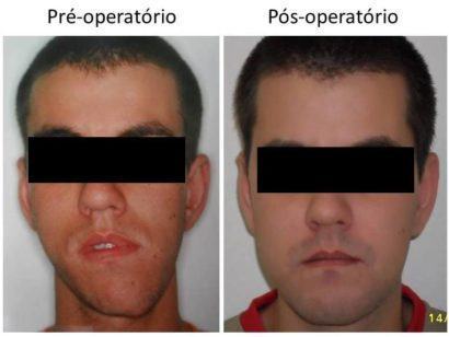 cirurgia para diminuir queijo grande