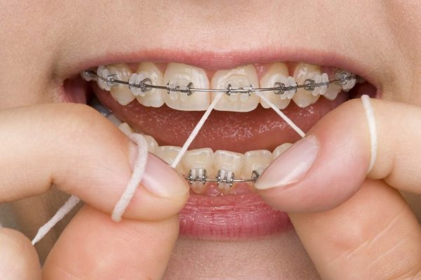 Dica: Como usar Fio Dental com Aparelho fixo