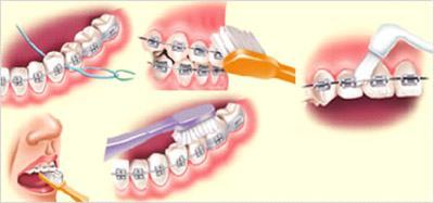 higienizacao e fio dental pra aparelho fixo