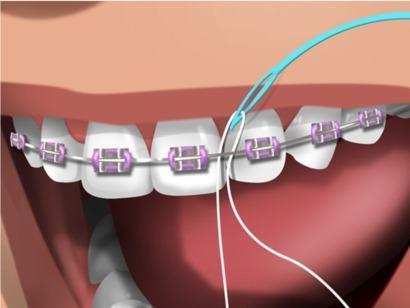 passador para usar fio dental com aparelho fixo