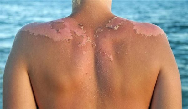 queimadura de sol pomadas