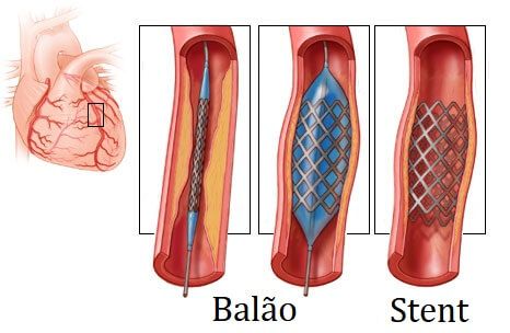 Cirurgia de Angioplastia Entenda Cada Ponto