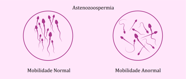 astenozoospermia