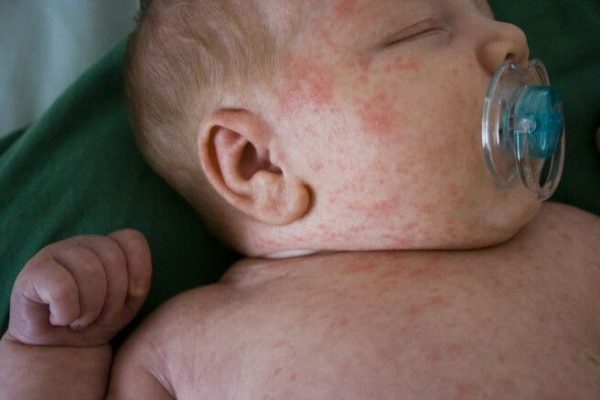 febre com manchas vermelhas no corpo do bebe