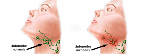 tuberculose ganglionar 490x189