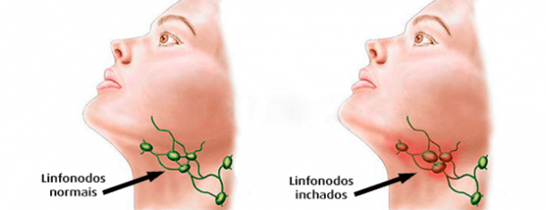 tuberculose ganglionar