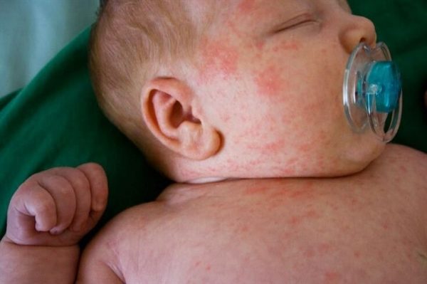 Pomada para bebê com Alergia na pele, Como Tratar