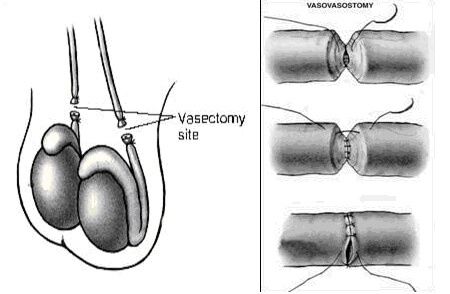 reversao de vasectomia