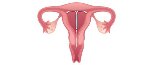 DIU para não menstruar mais