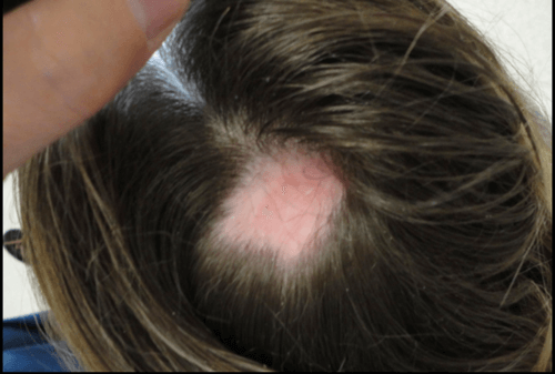 alopecia cicatricial