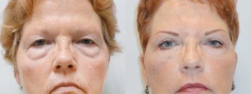 blefaroplastia antes e depois 2 490x184