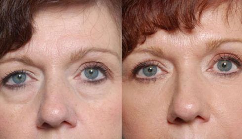 blefaroplastia antes e depois 3 490x282