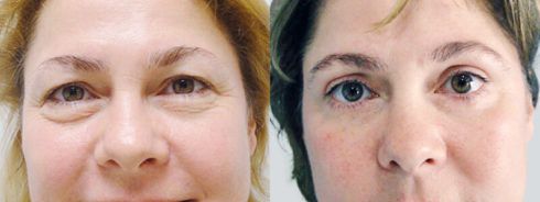 blefaroplastia antes e depois 4 490x184