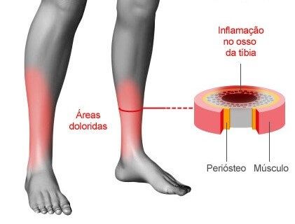 Antiinflamatório para Canelite, dor na Canela, Nomes