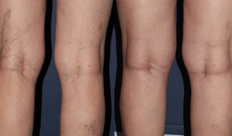 escleroterapia antes e depois