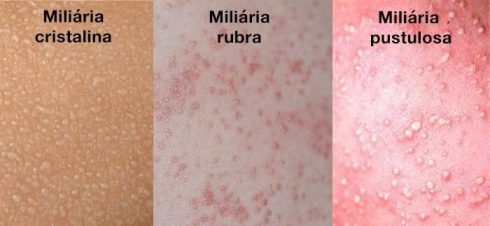 miliaria na pele 490x226