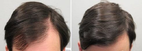 minoxidil queda de cabelo antes e depois 490x176