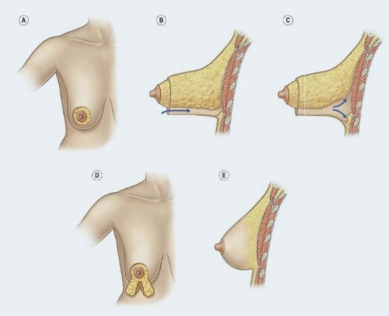 Mama Tuberosa Mamoplastia para Aumento, Conheça