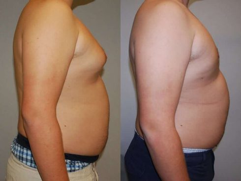 resultado antes e depois cirurgia de ginecomastia 490x368