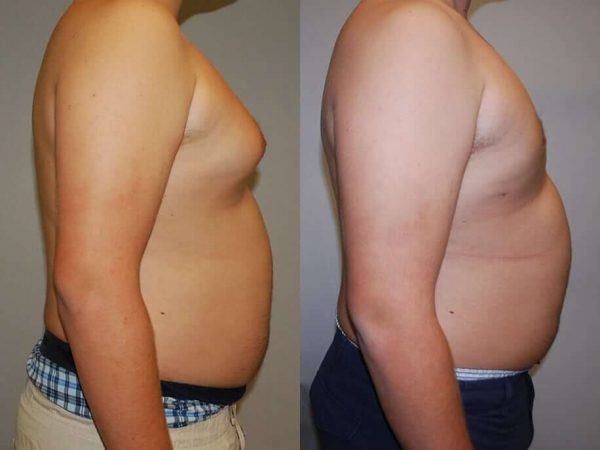 resultado antes e depois cirurgia de ginecomastia