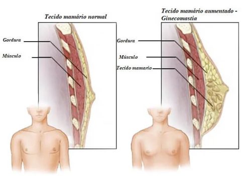 Individuo com ginecomastia e indivíduo normal